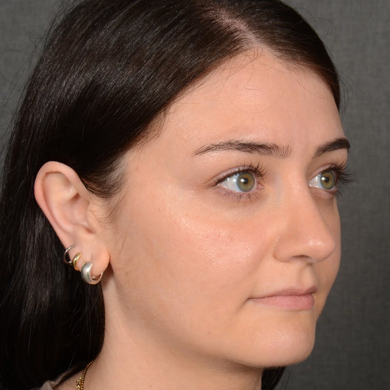 Female Rhinoplasty Before & After Gallery - Patient 394381 - Image 4