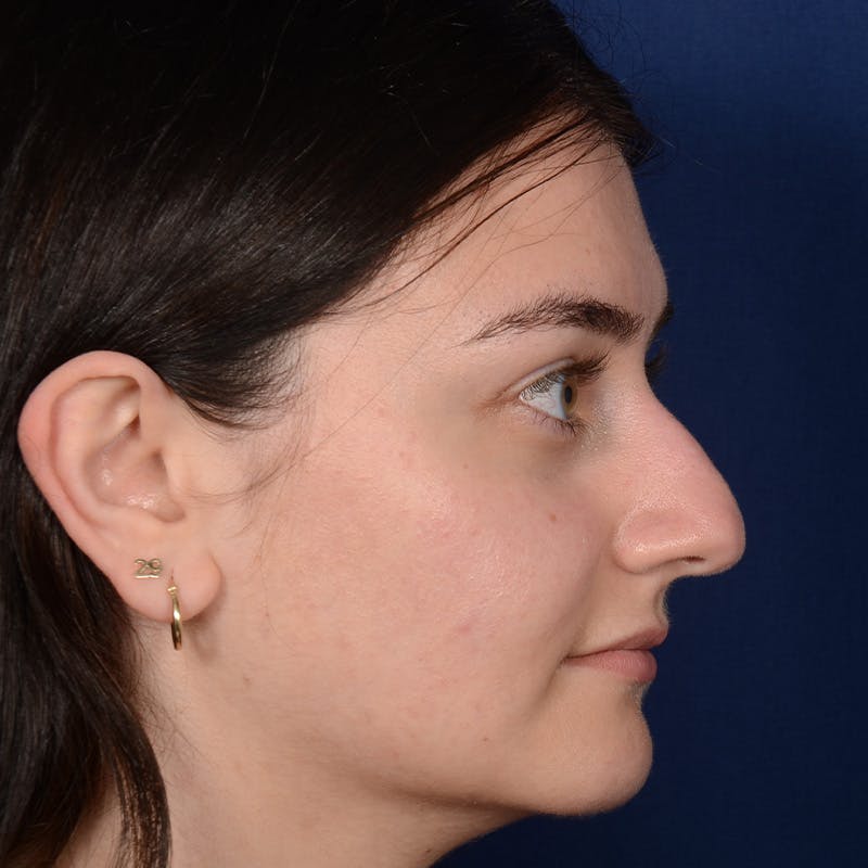 Female Rhinoplasty Before & After Gallery - Patient 394381 - Image 5
