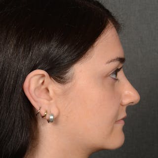 Female Rhinoplasty Before & After Gallery - Patient 394381 - Image 6