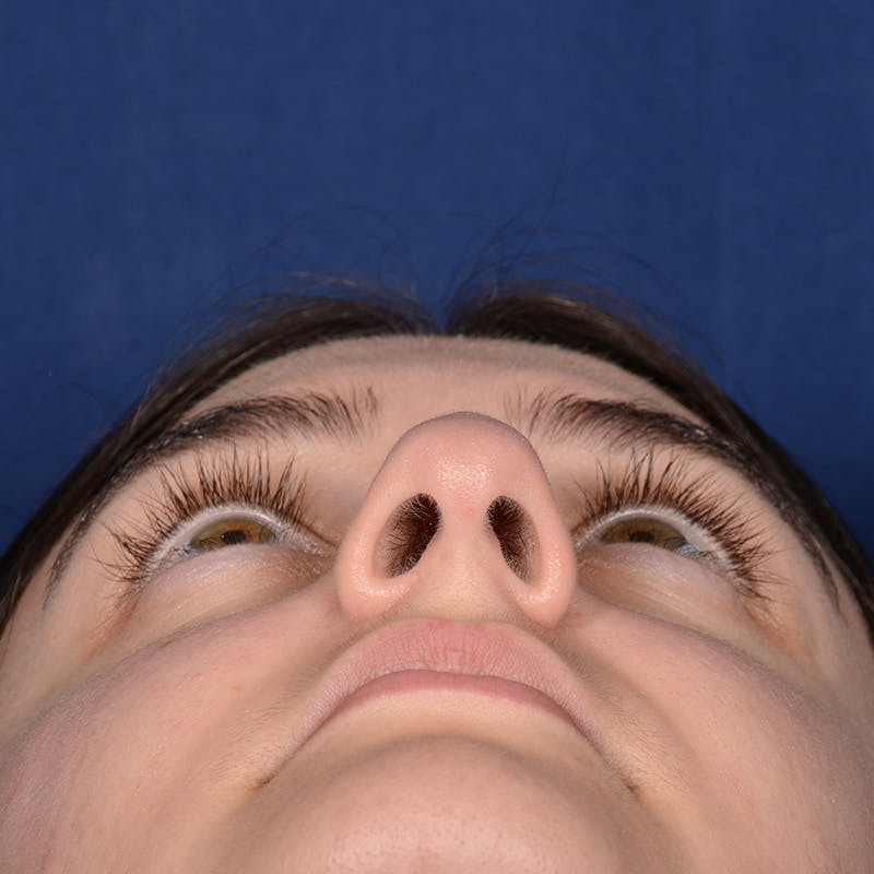 Female Rhinoplasty Before & After Gallery - Patient 394381 - Image 7