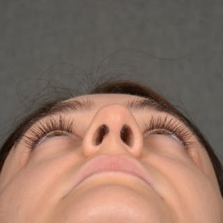 Female Rhinoplasty Before & After Gallery - Patient 394381 - Image 8