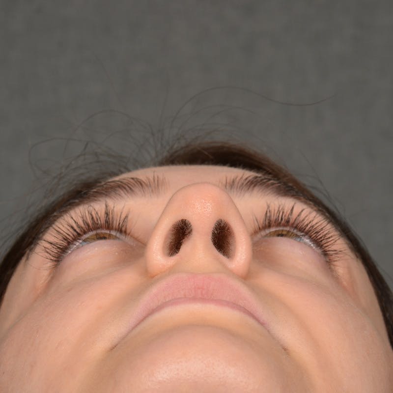 Female Rhinoplasty Before & After Gallery - Patient 394381 - Image 8