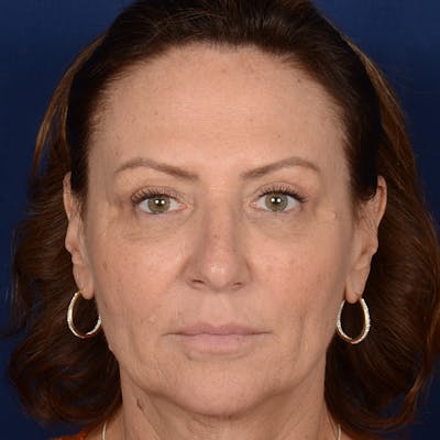 Female Rhinoplasty Before & After Gallery - Patient 103082 - Image 1
