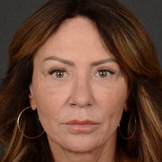 Female Rhinoplasty Before & After Gallery - Patient 103082 - Image 2