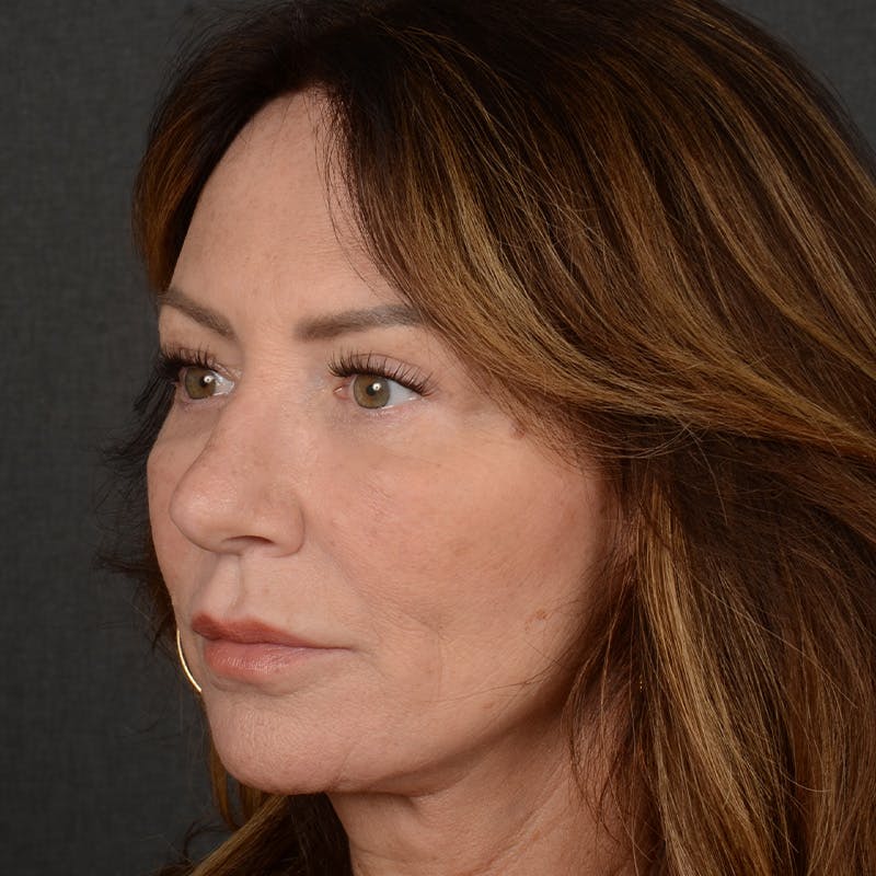 Female Rhinoplasty Before & After Gallery - Patient 103082 - Image 4