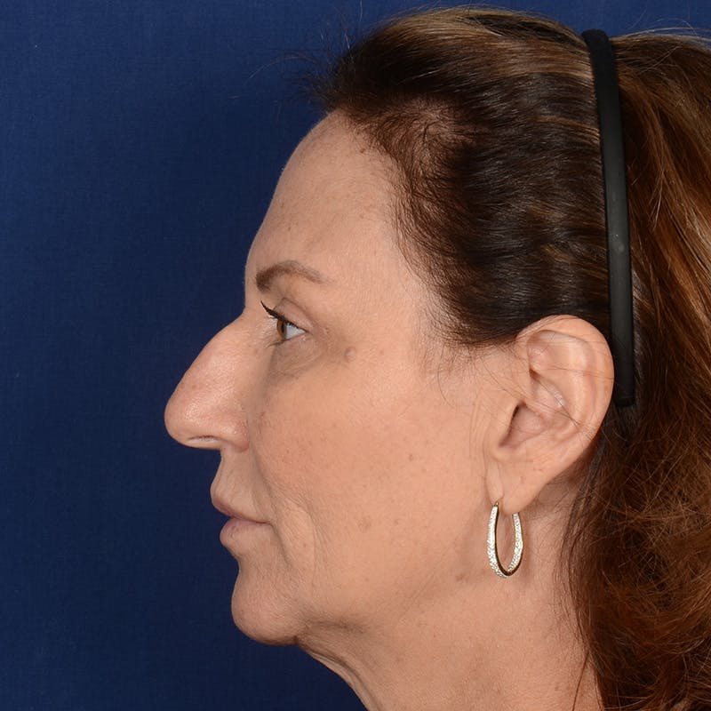 Female Rhinoplasty Before & After Gallery - Patient 103082 - Image 5