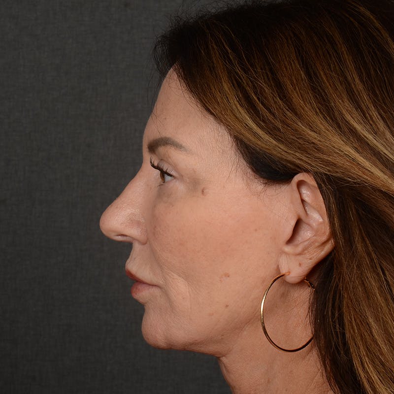 Female Rhinoplasty Before & After Gallery - Patient 103082 - Image 6