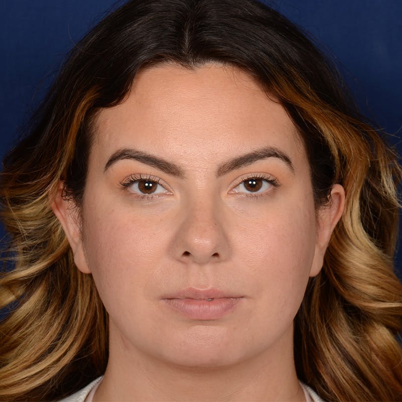 Female Rhinoplasty Before & After Gallery - Patient 316128 - Image 1