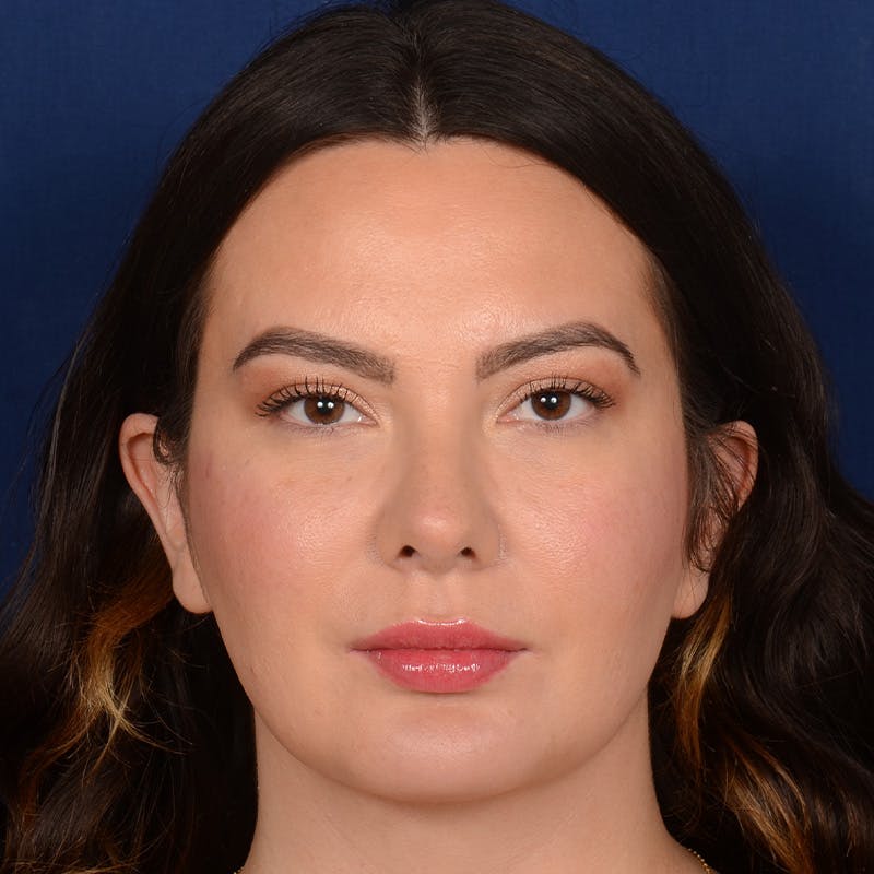 Female Rhinoplasty Before & After Gallery - Patient 316128 - Image 2