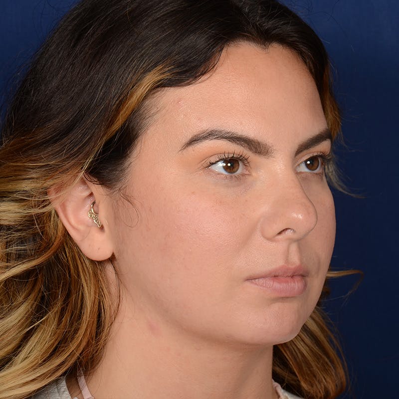 Female Rhinoplasty Before & After Gallery - Patient 316128 - Image 3