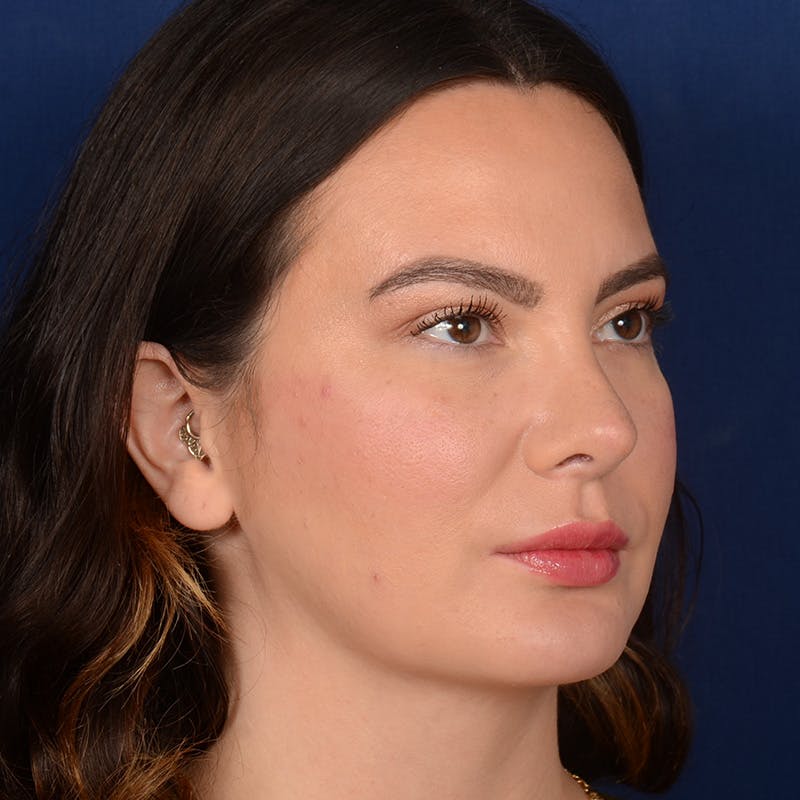Female Rhinoplasty Before & After Gallery - Patient 316128 - Image 4