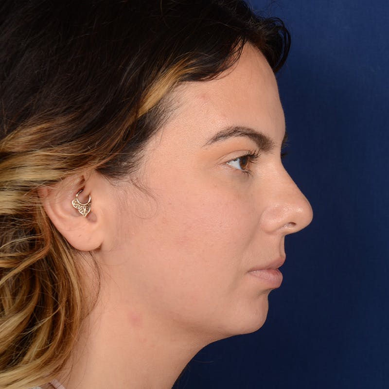 Female Rhinoplasty Before & After Gallery - Patient 316128 - Image 5