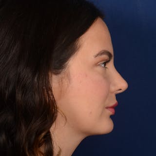 Female Rhinoplasty Before & After Gallery - Patient 316128 - Image 6