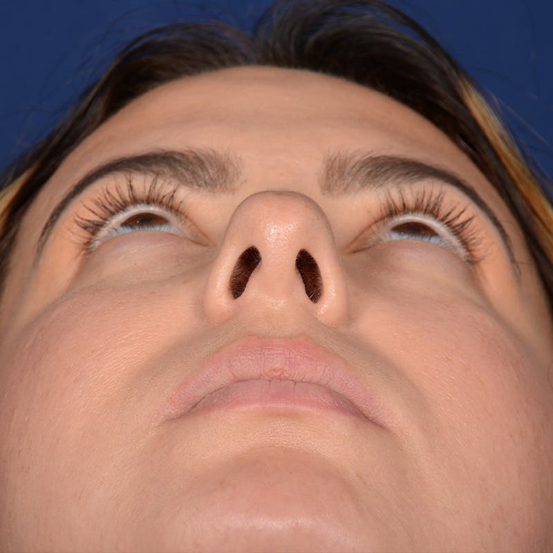 Female Rhinoplasty Before & After Gallery - Patient 316128 - Image 7