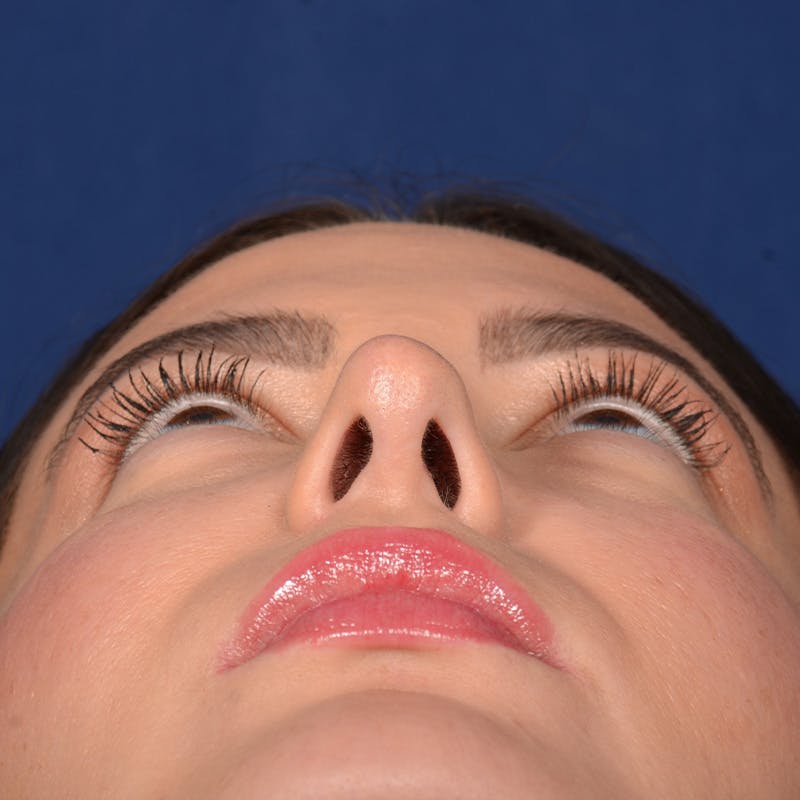 Female Rhinoplasty Before & After Gallery - Patient 316128 - Image 8