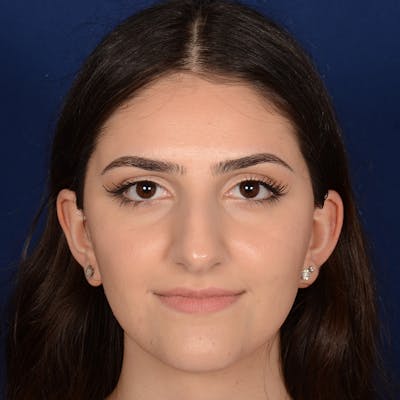 Female Rhinoplasty Before & After Gallery - Patient 203837 - Image 1