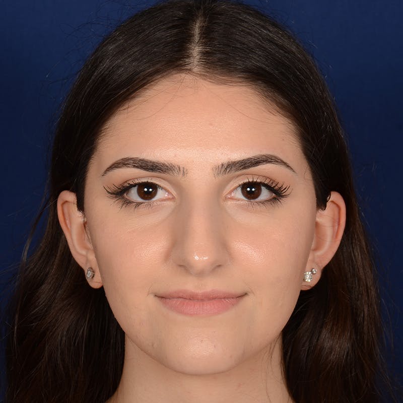 Female Rhinoplasty Before & After Gallery - Patient 203837 - Image 1
