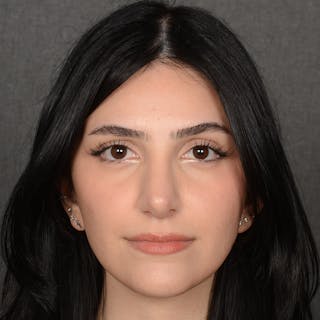 Female Rhinoplasty Before & After Gallery - Patient 203837 - Image 2