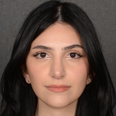 Female Rhinoplasty Before & After Gallery - Patient 203837 - Image 2