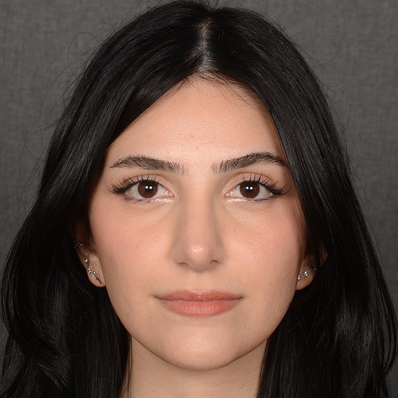 Female Rhinoplasty Before & After Gallery - Patient 203837 - Image 2