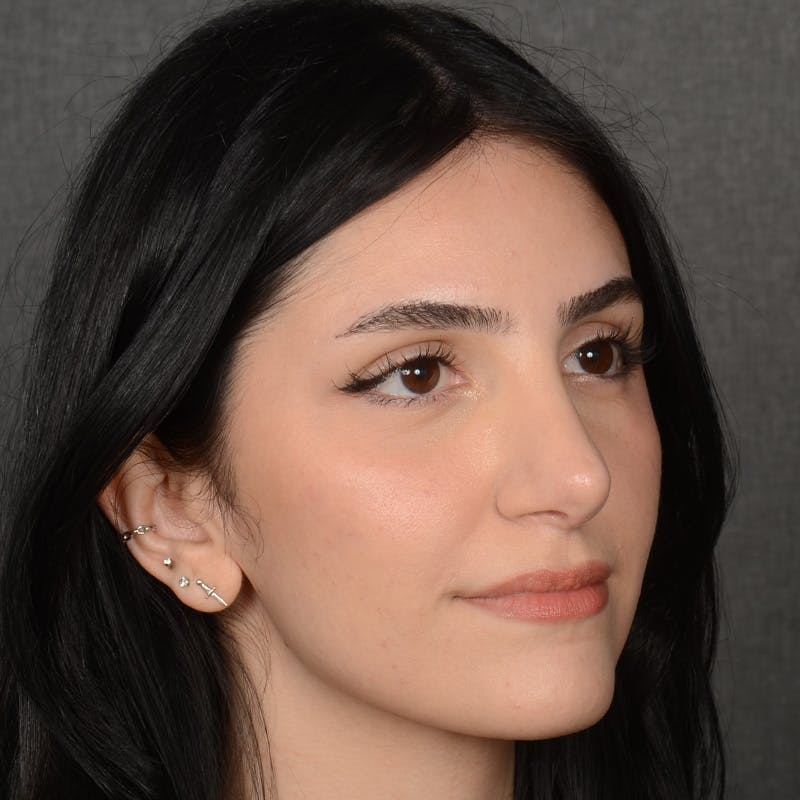 Female Rhinoplasty Before & After Gallery - Patient 203837 - Image 4