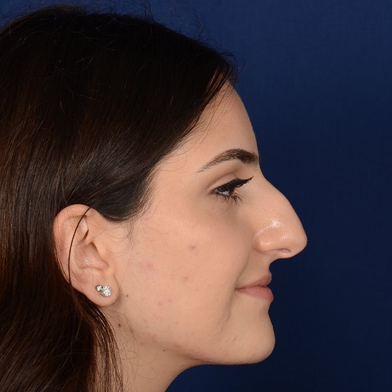 Female Rhinoplasty Before & After Gallery - Patient 203837 - Image 5