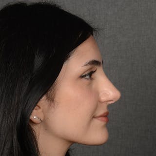 Female Rhinoplasty Before & After Gallery - Patient 203837 - Image 6