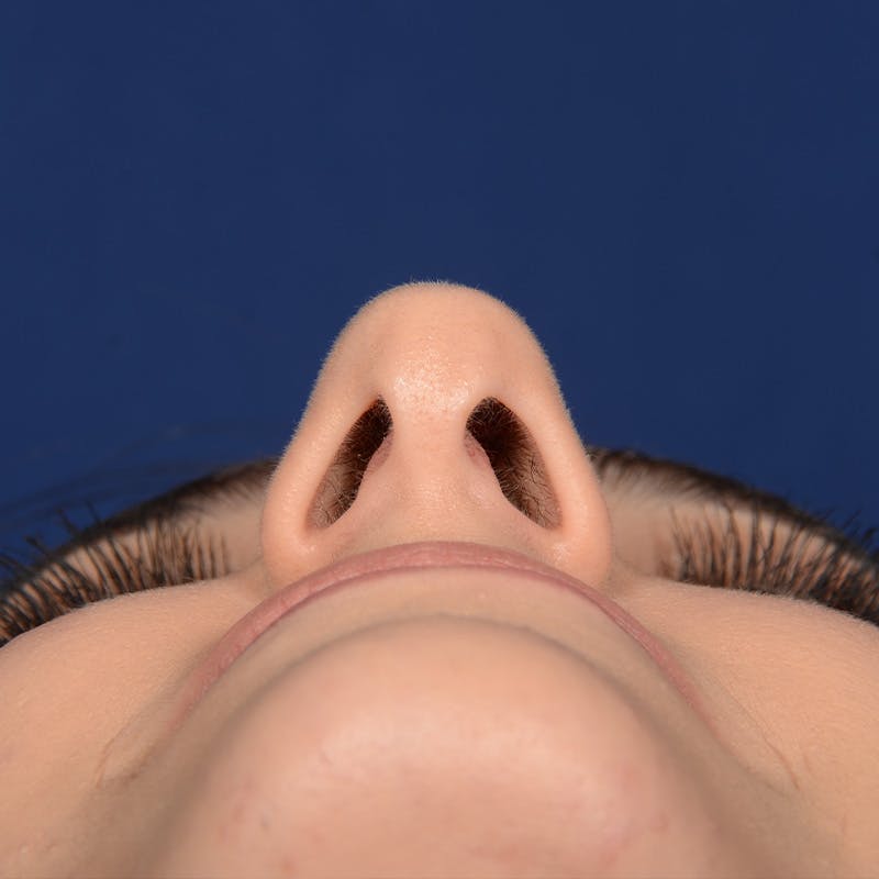 Female Rhinoplasty Before & After Gallery - Patient 203837 - Image 7