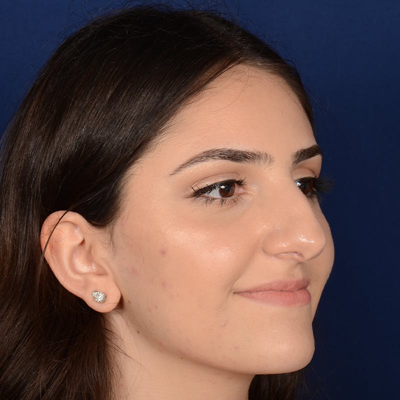 Female Rhinoplasty Before & After Gallery - Patient 203837 - Image 3