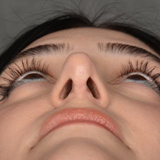 Female Rhinoplasty Before & After Gallery - Patient 203837 - Image 8
