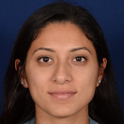 Female Rhinoplasty Before & After Gallery - Patient 302650 - Image 1