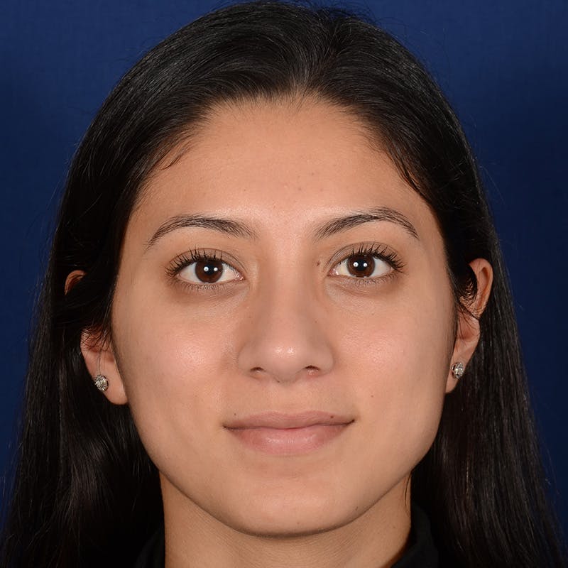 Female Rhinoplasty Before & After Gallery - Patient 302650 - Image 2