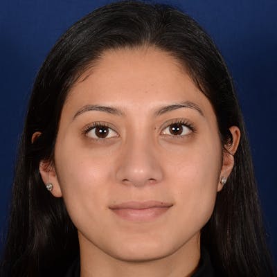 Female Rhinoplasty Before & After Gallery - Patient 302650 - Image 2
