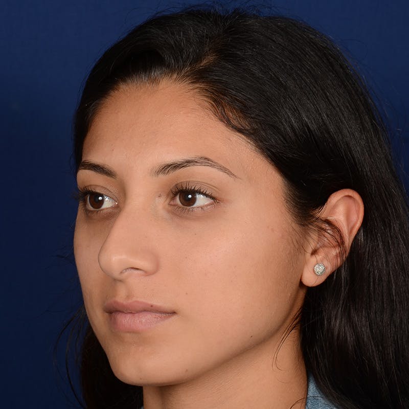 Female Rhinoplasty Before & After Gallery - Patient 302650 - Image 3