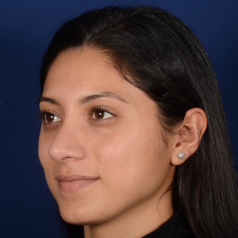 Female Rhinoplasty Before & After Gallery - Patient 302650 - Image 4