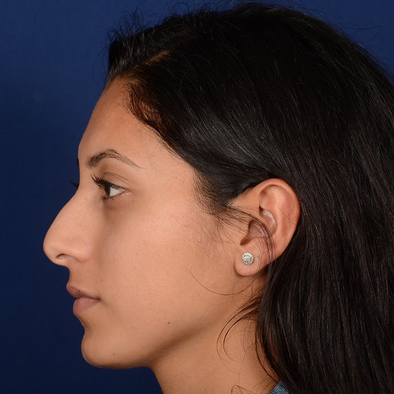 Female Rhinoplasty Before & After Gallery - Patient 302650 - Image 5