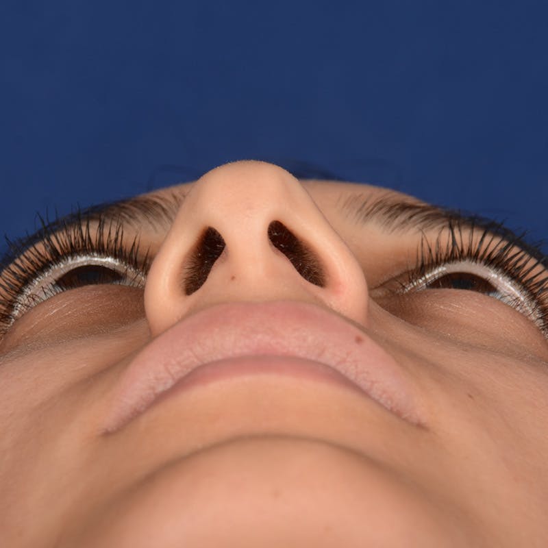 Female Rhinoplasty Before & After Gallery - Patient 302650 - Image 7