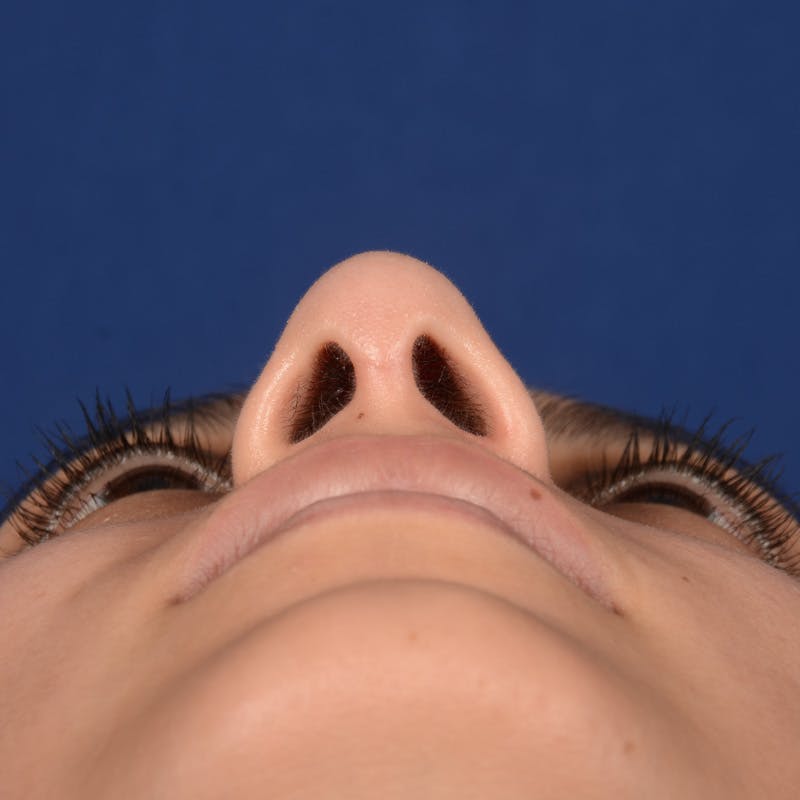 Female Rhinoplasty Before & After Gallery - Patient 302650 - Image 8