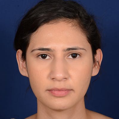 Female Rhinoplasty Before & After Gallery - Patient 573189 - Image 1