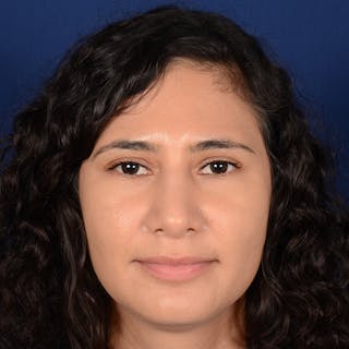 Female Rhinoplasty Before & After Gallery - Patient 573189 - Image 2