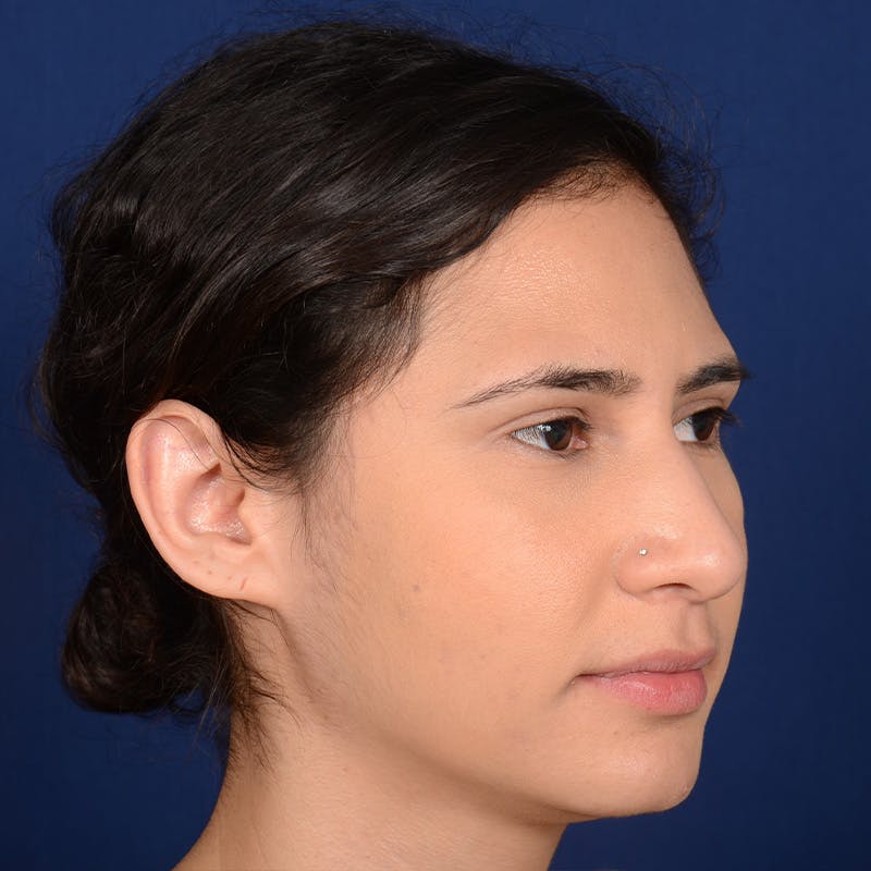 Female Rhinoplasty Before & After Gallery - Patient 573189 - Image 3