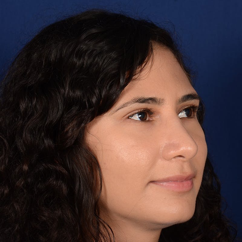 Female Rhinoplasty Before & After Gallery - Patient 573189 - Image 4