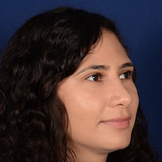 Female Rhinoplasty Before & After Gallery - Patient 573189 - Image 4
