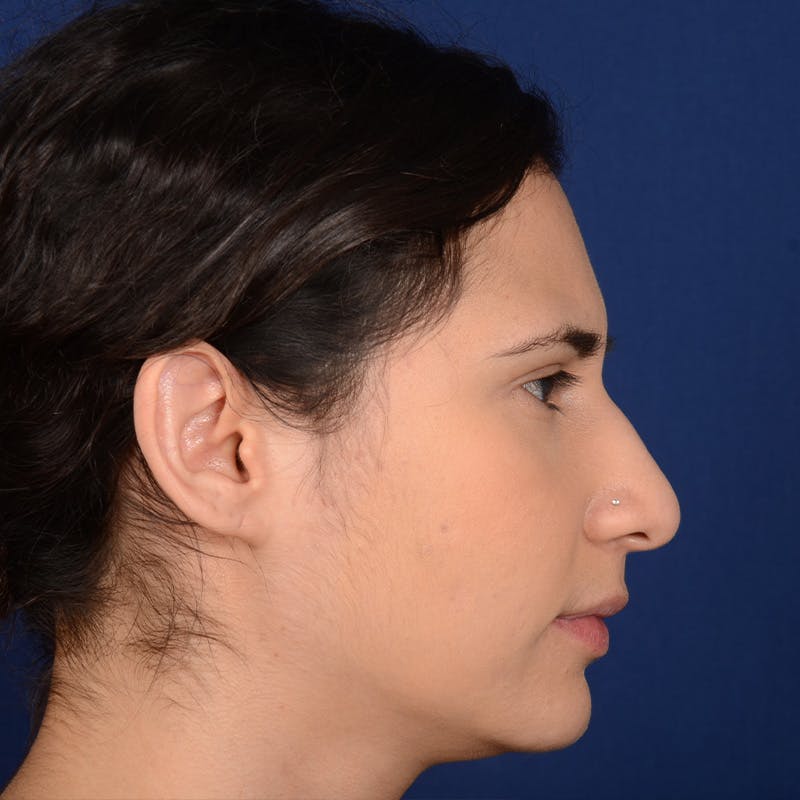 Female Rhinoplasty Before & After Gallery - Patient 573189 - Image 5