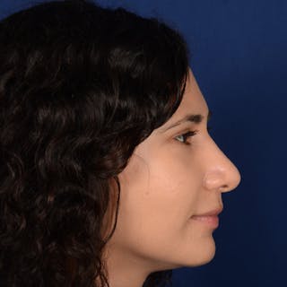 Female Rhinoplasty Before & After Gallery - Patient 573189 - Image 6