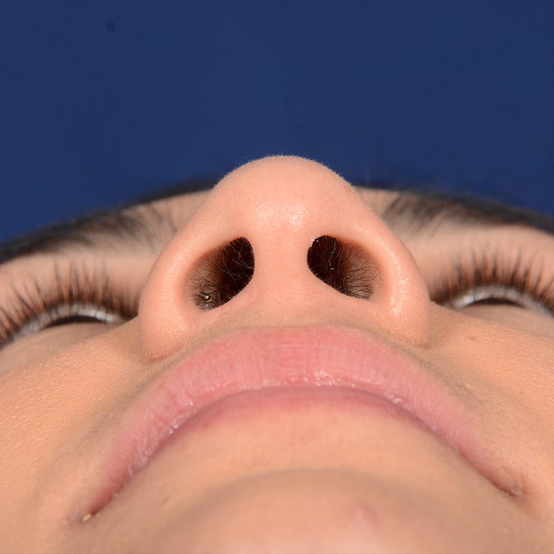 Female Rhinoplasty Before & After Gallery - Patient 573189 - Image 7