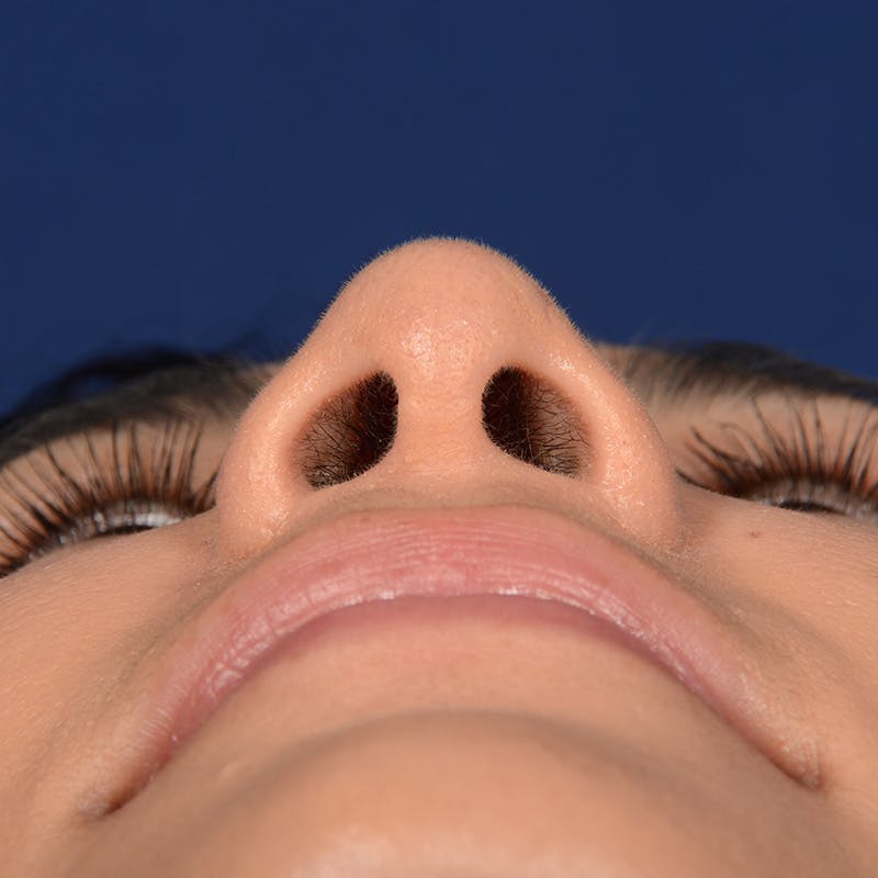 Female Rhinoplasty Before & After Gallery - Patient 573189 - Image 8
