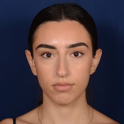 Female Rhinoplasty Before & After Gallery - Patient 238657 - Image 1