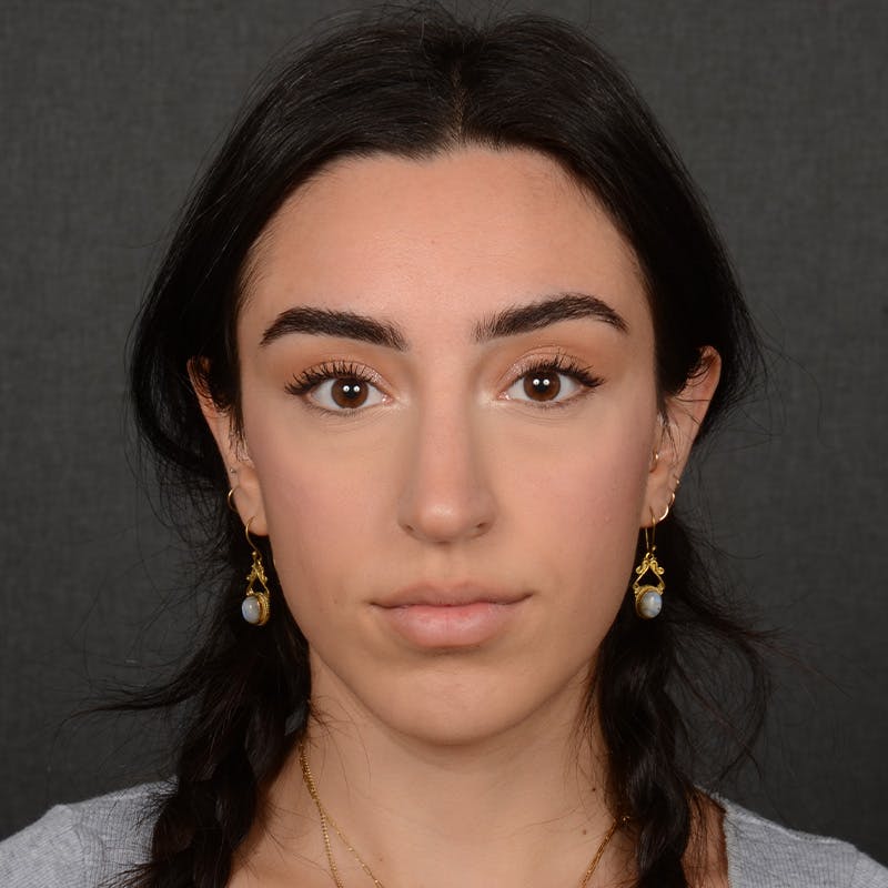 Female Rhinoplasty Before & After Gallery - Patient 238657 - Image 2