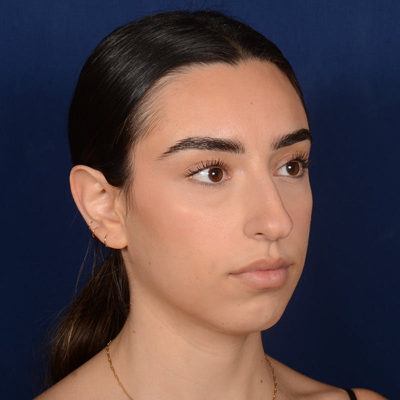 Female Rhinoplasty Before & After Gallery - Patient 238657 - Image 3